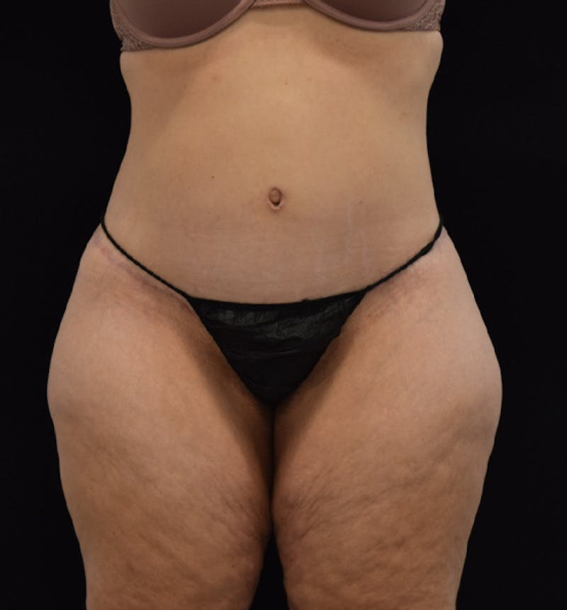 Lower Body Lift Before & After Gallery - Patient 102564155 - Image 2