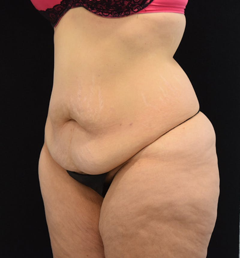 Lower Body Lift Before & After Gallery - Patient 102564155 - Image 3