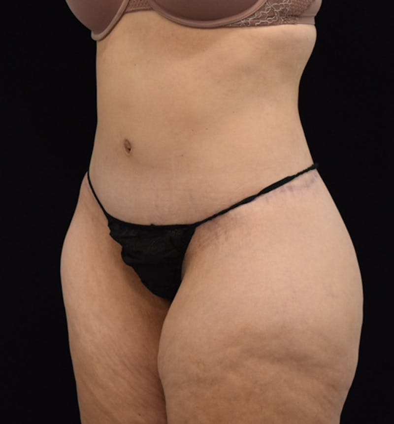 Lower Body Lift Before & After Gallery - Patient 102564155 - Image 4