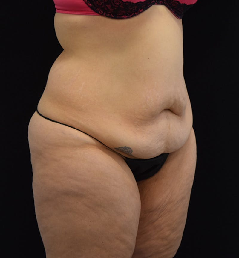 Lower Body Lift Before & After Gallery - Patient 102564155 - Image 7