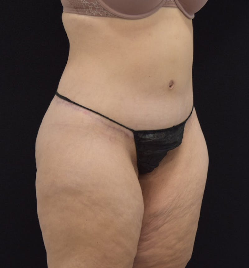 Lower Body Lift Before & After Gallery - Patient 102564155 - Image 8