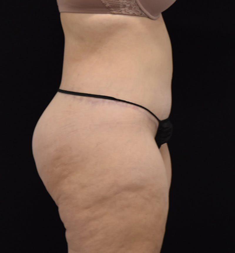 Lower Body Lift Before & After Gallery - Patient 102564155 - Image 10