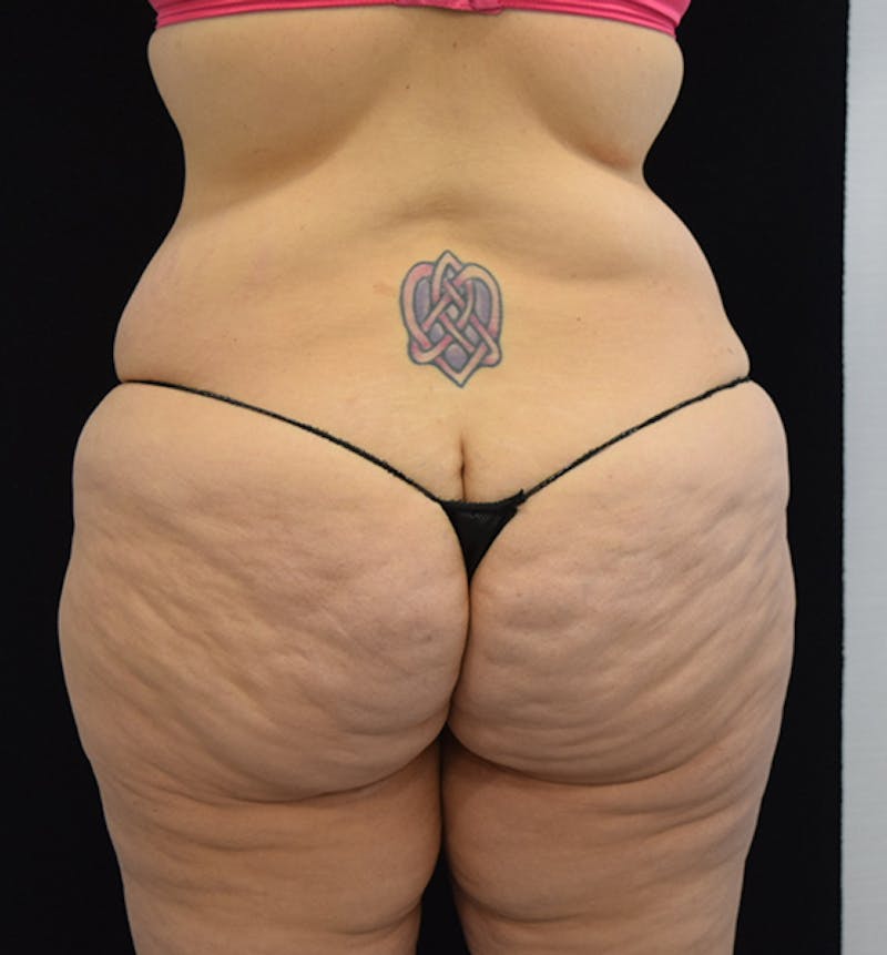 Lower Body Lift Before & After Gallery - Patient 102564155 - Image 11
