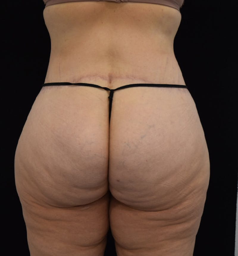 Lower Body Lift Before & After Gallery - Patient 102564155 - Image 12