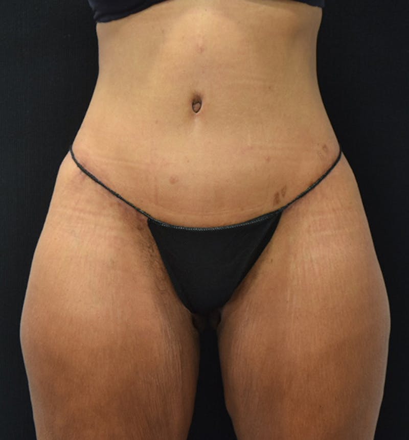 Lower Body Lift Before & After Gallery - Patient 102564169 - Image 2