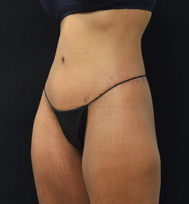 Lower Body Lift Before & After Gallery - Patient 102564169 - Image 4