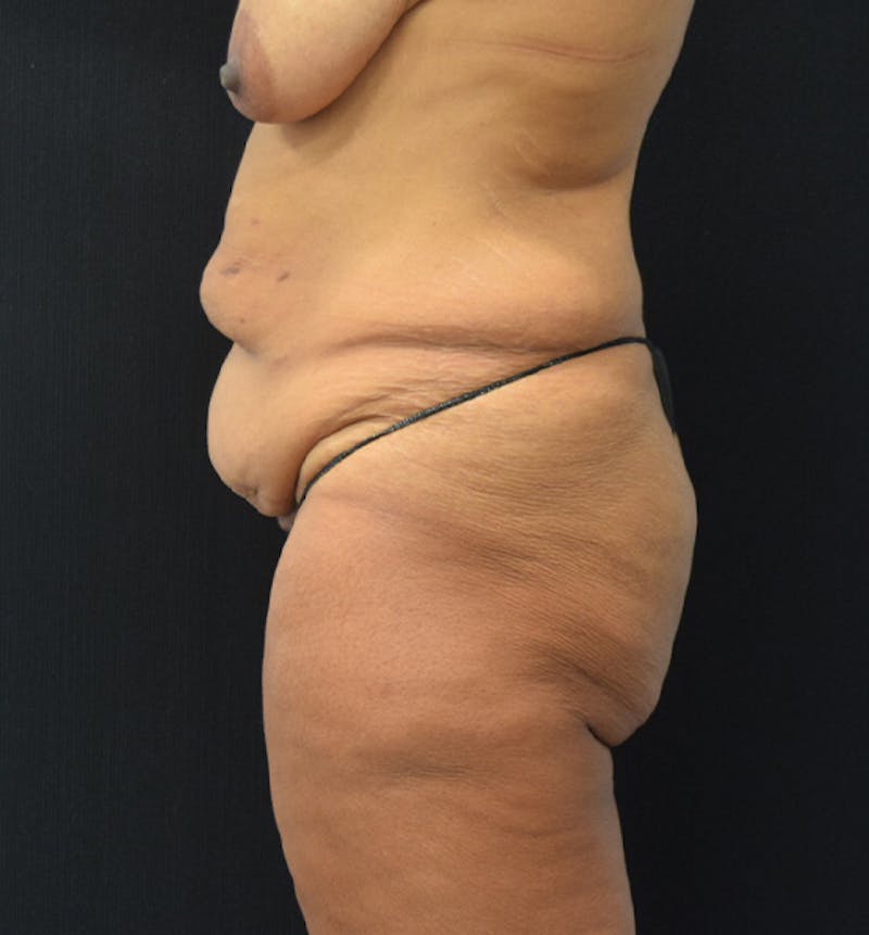 Lower Body Lift Before & After Gallery - Patient 102564169 - Image 5