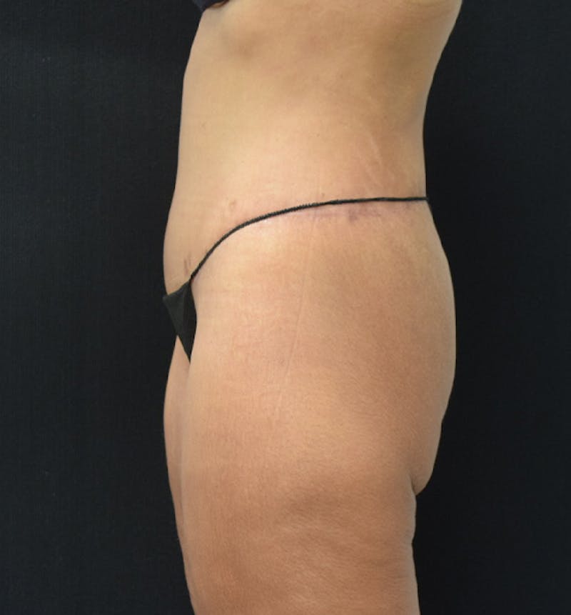 Lower Body Lift Before & After Gallery - Patient 102564169 - Image 6