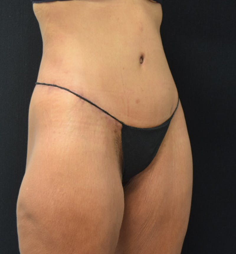 Lower Body Lift Before & After Gallery - Patient 102564169 - Image 8