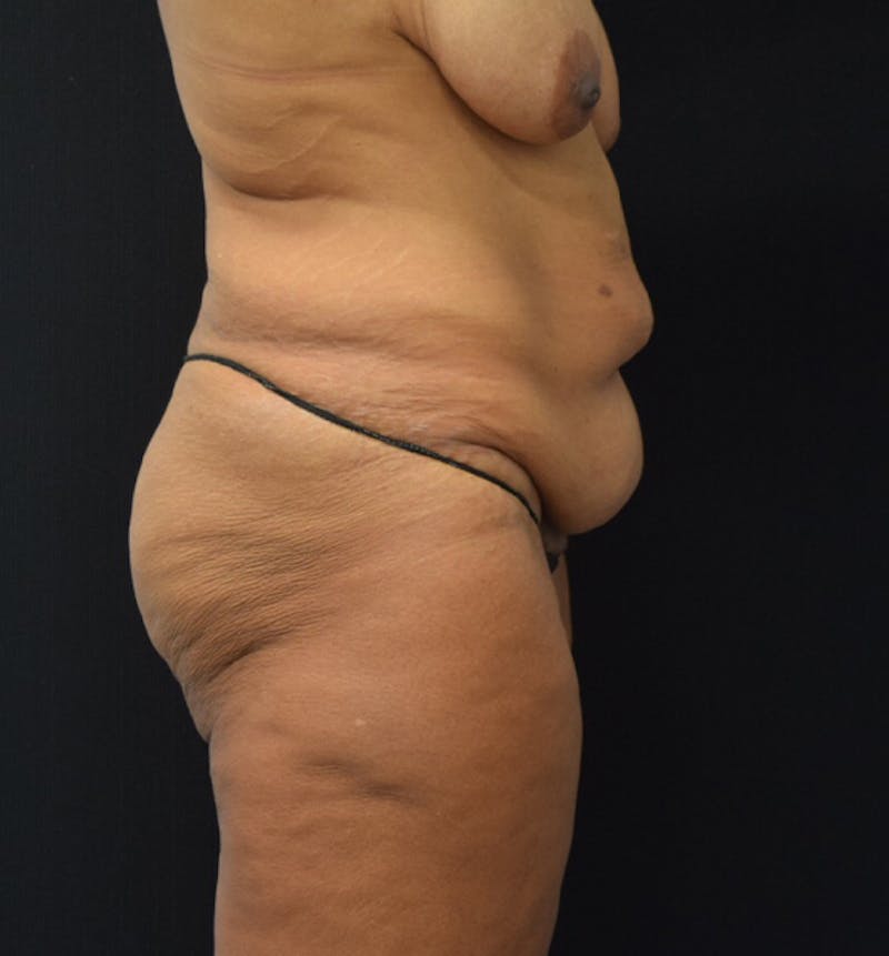 Lower Body Lift Before & After Gallery - Patient 102564169 - Image 9