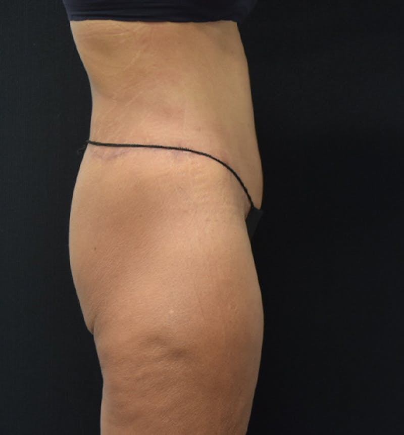 Lower Body Lift Before & After Gallery - Patient 102564169 - Image 10