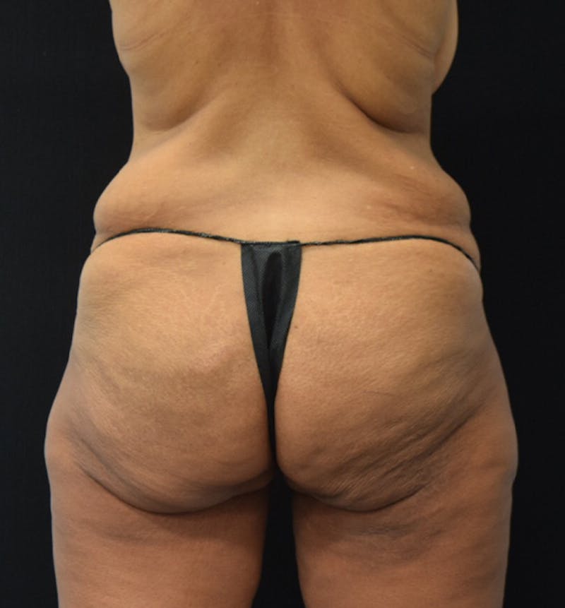 Lower Body Lift Gallery - Patient 102564169 - Image 11