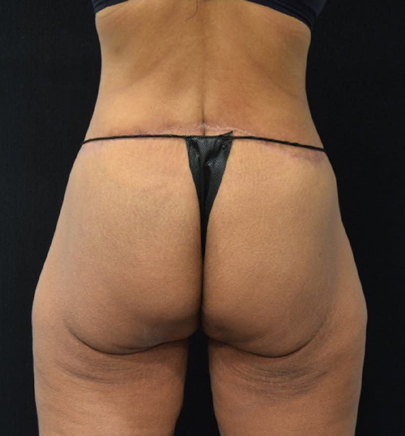 Lower Body Lift Before & After Gallery - Patient 102564169 - Image 12