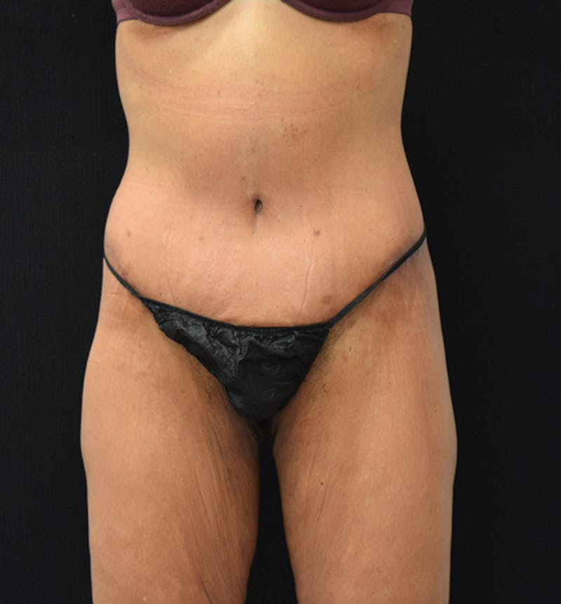 Lower Body Lift Before & After Gallery - Patient 102564187 - Image 2