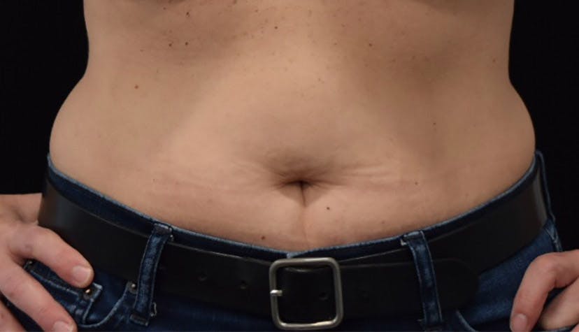 Liposuction in Long Island Before & After Photos