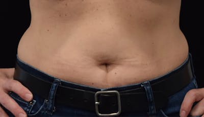 Liposuction Before & After Gallery - Patient 102564186 - Image 1