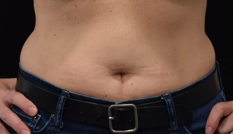 Liposuction Before & After Gallery - Patient 102564186 - Image 1