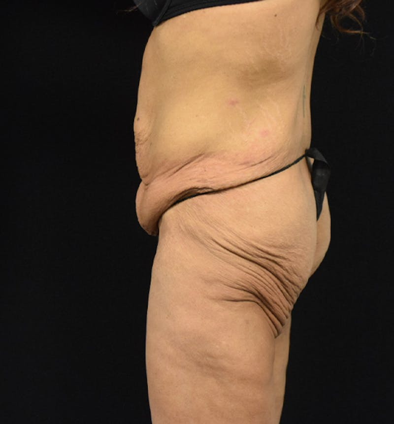 Lower Body Lift Before & After Gallery - Patient 102564187 - Image 5