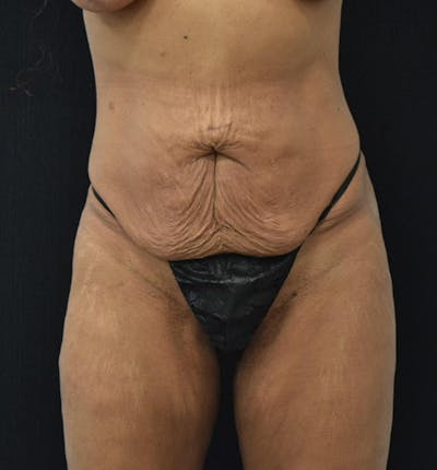 Fat Transfer Before & After Gallery - Patient 102564201 - Image 1