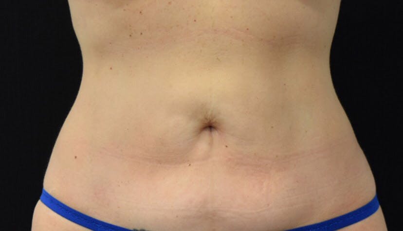 Liposuction in Long Island Before & After Photos