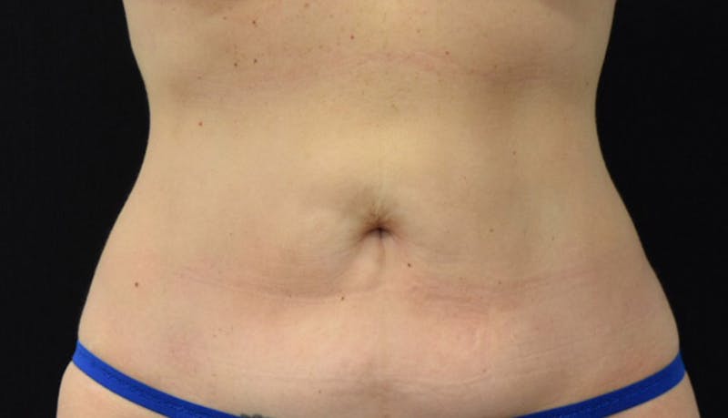 Liposuction Gallery - Patient 102564186 - Image 2