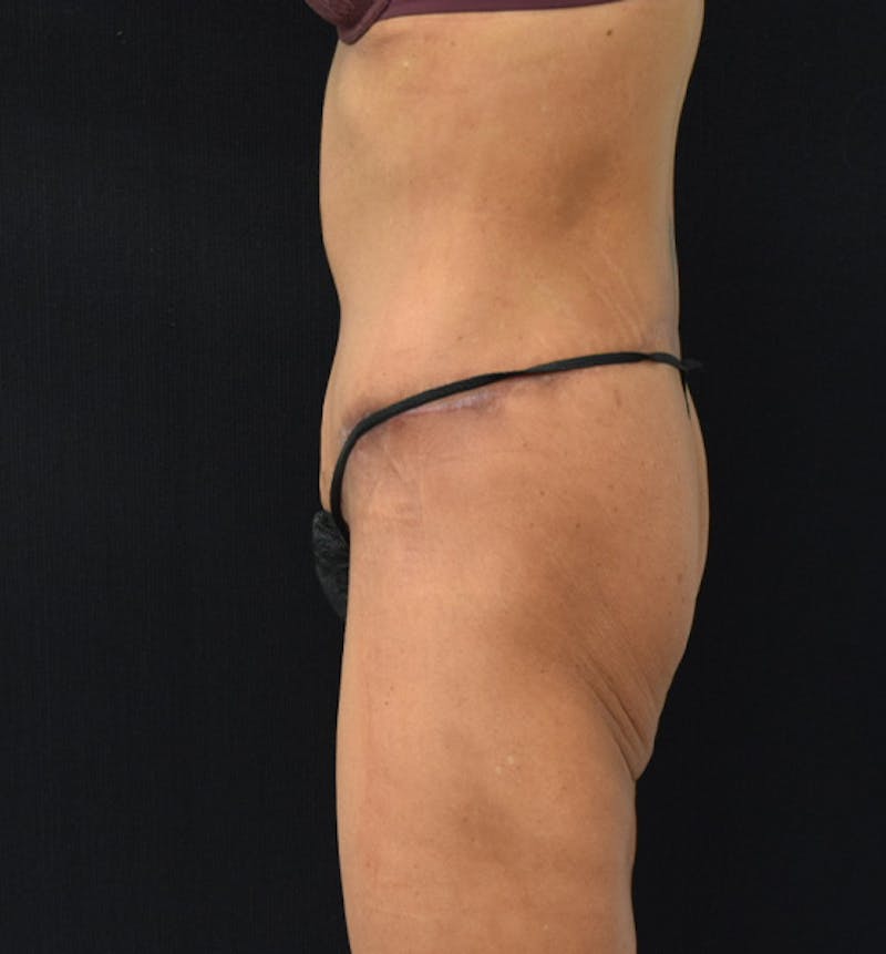 Lower Body Lift Before & After Gallery - Patient 102564187 - Image 6