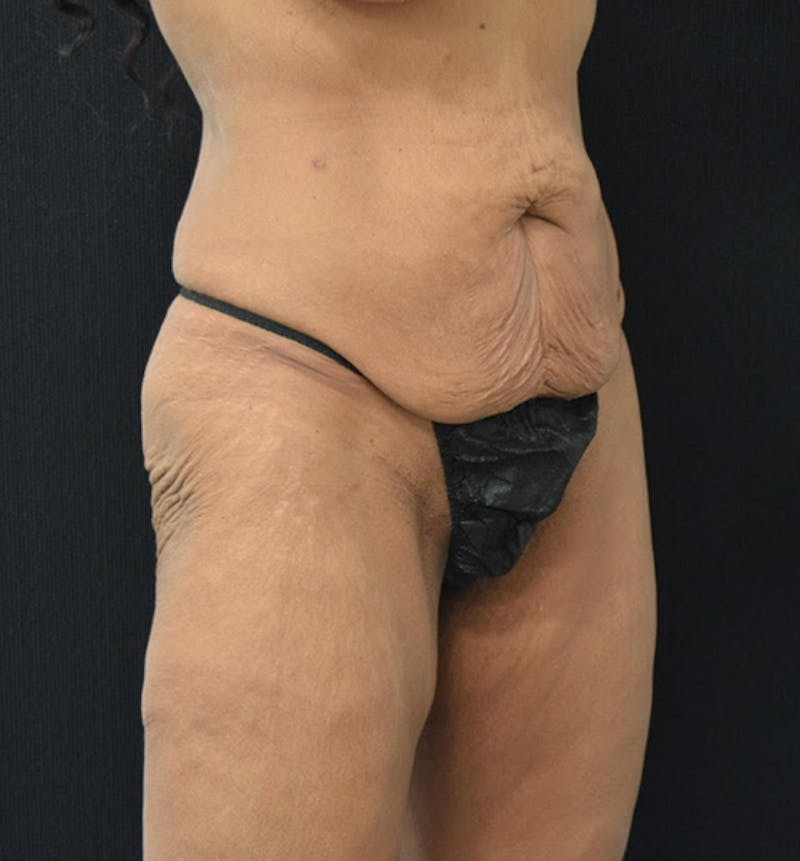 Fat Transfer Gallery - Patient 102564201 - Image 3