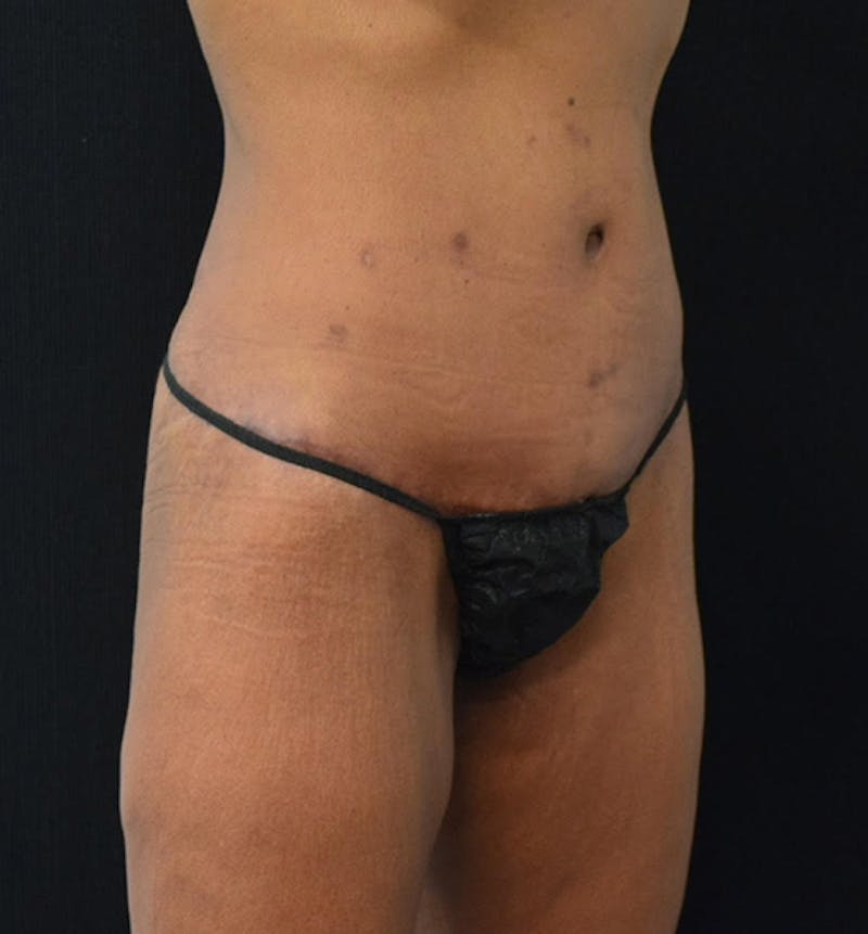 Fat Transfer to Buttock Before & After Gallery - Patient 102564201 - Image 4