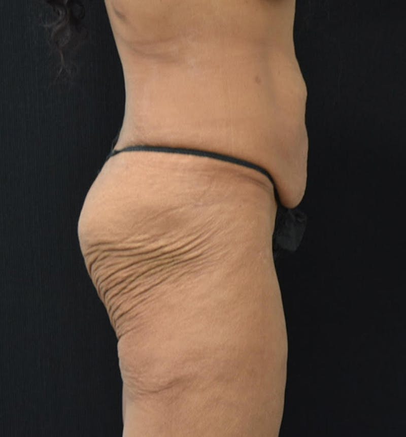 Fat Transfer to Buttock Before & After Gallery - Patient 102564201 - Image 5