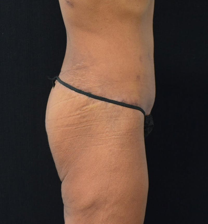 Fat Transfer Before & After Gallery - Patient 102564201 - Image 6