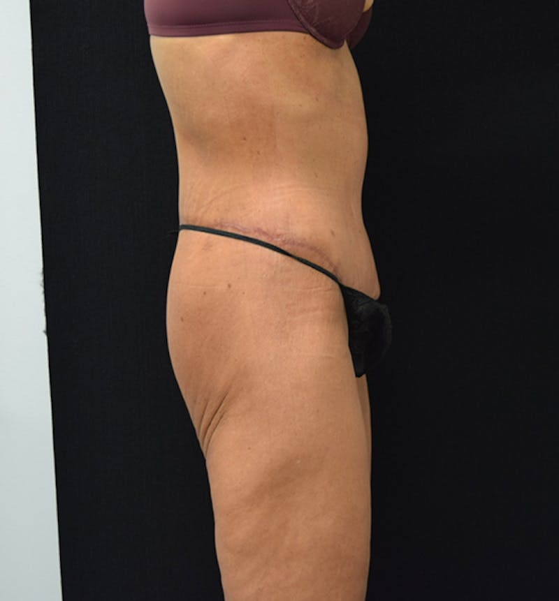 Lower Body Lift Before & After Gallery - Patient 102564187 - Image 10