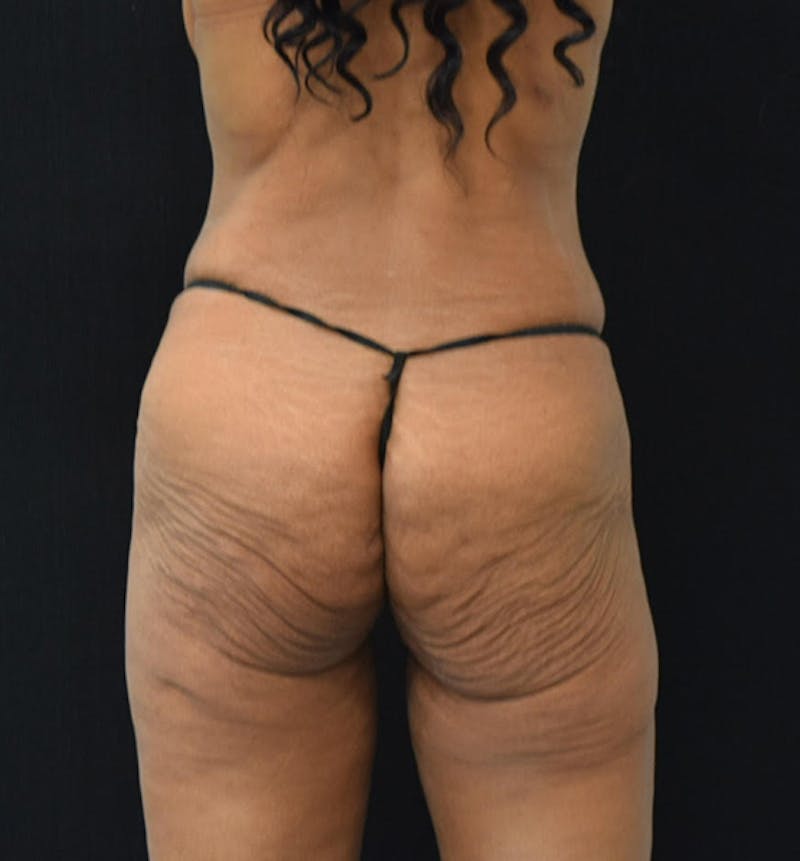 Fat Transfer to Buttock Before & After Gallery - Patient 102564201 - Image 7