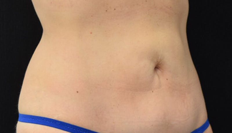 Liposuction Before & After Gallery - Patient 102564186 - Image 4