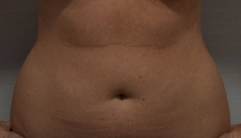 Liposuction Gallery - Patient 102564188 - Image 1