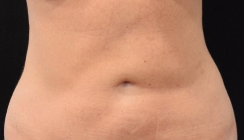 Liposuction Gallery - Patient 102564188 - Image 2