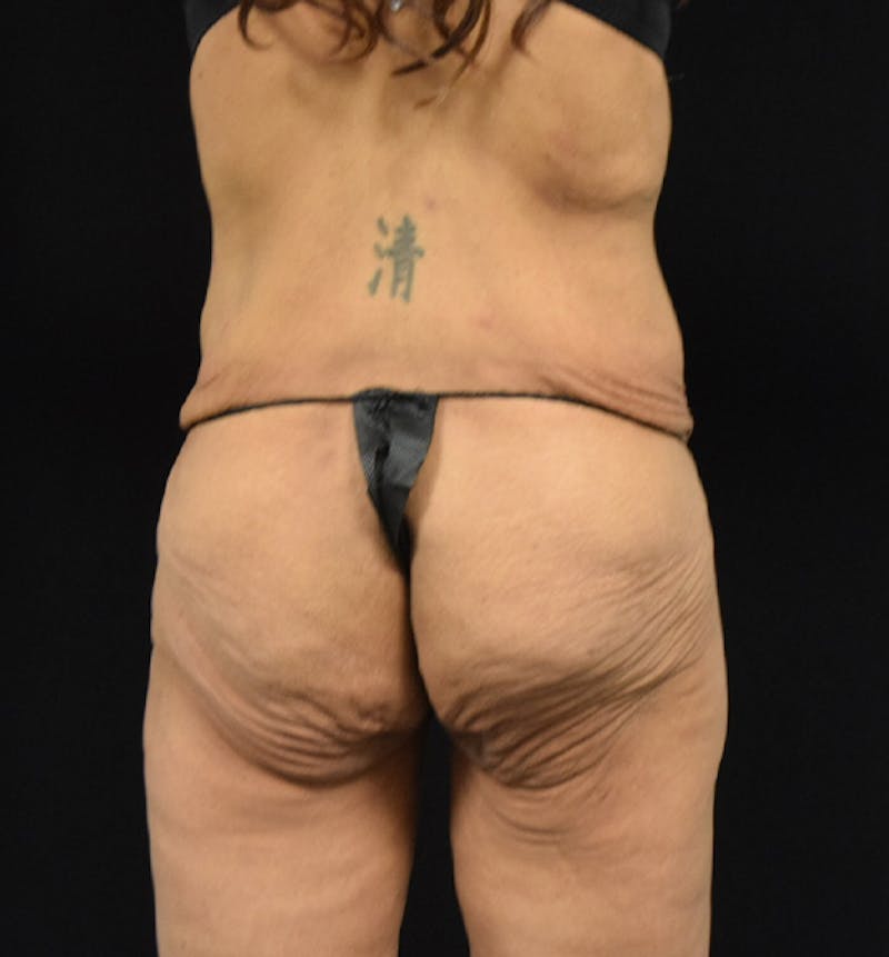 Lower Body Lift Before & After Gallery - Patient 102564187 - Image 11