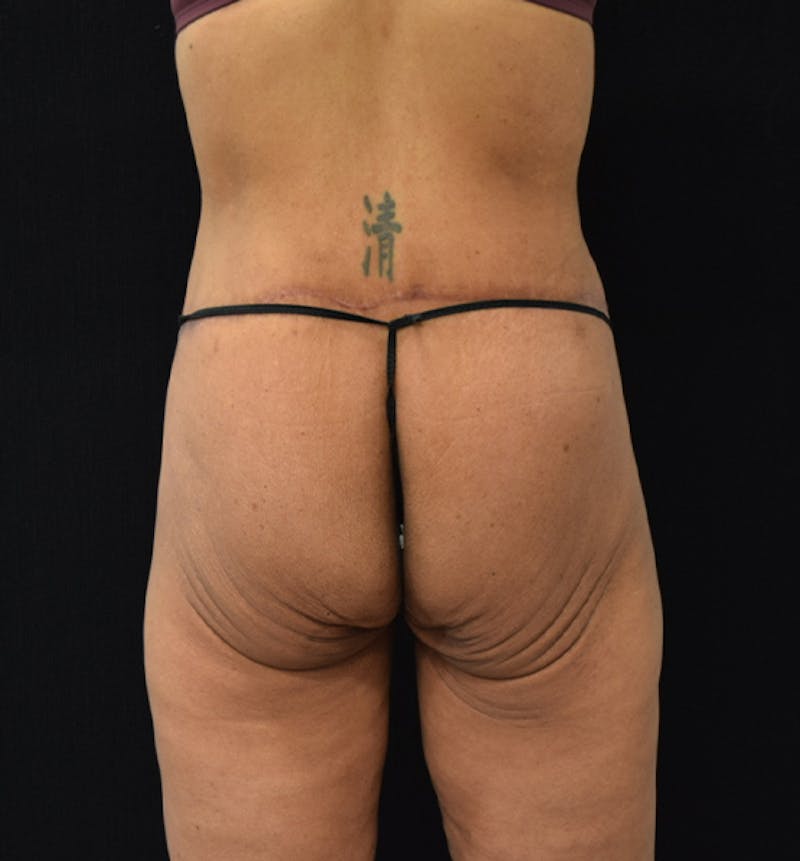 Lower Body Lift Before & After Gallery - Patient 102564187 - Image 12
