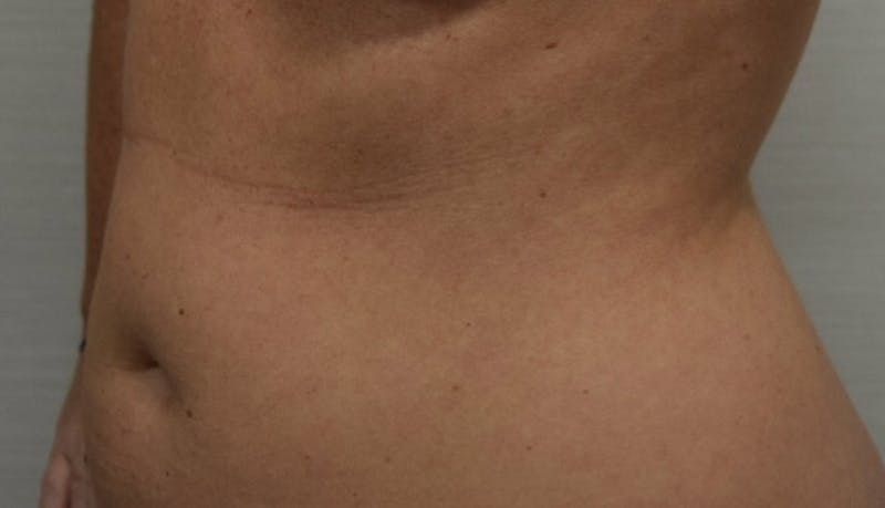 Liposuction Before & After Gallery - Patient 102564188 - Image 3