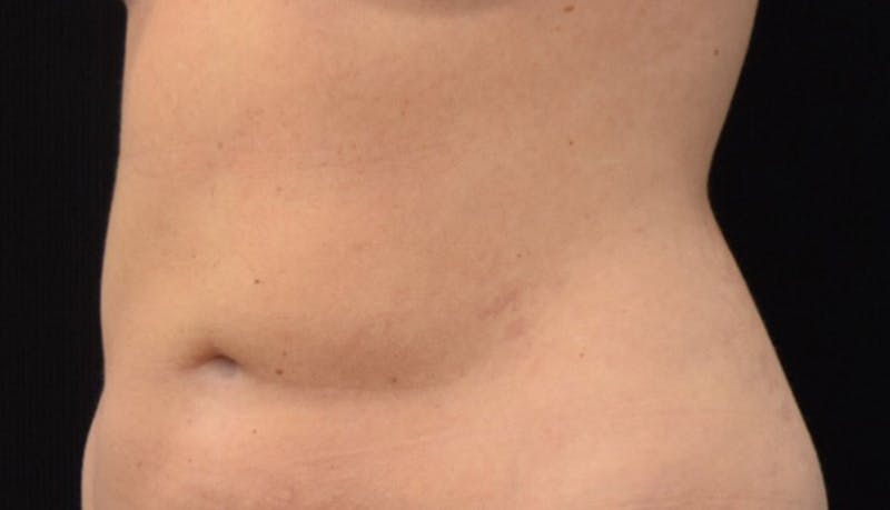 Liposuction Before & After Gallery - Patient 102564188 - Image 4