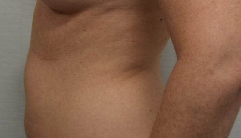Liposuction Before & After Gallery - Patient 102564188 - Image 5