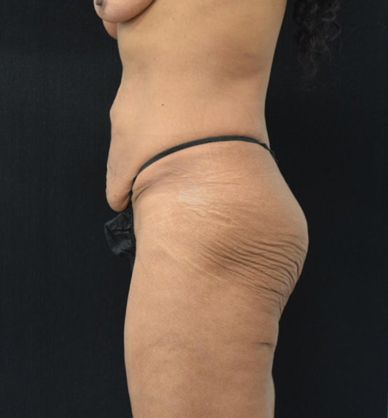 Fat Transfer Gallery - Patient 102564201 - Image 9