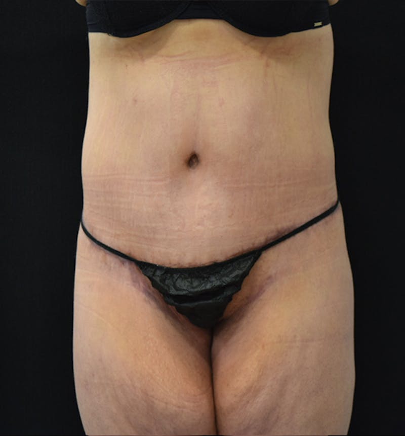 Lower Body Lift Before & After Gallery - Patient 102564202 - Image 2