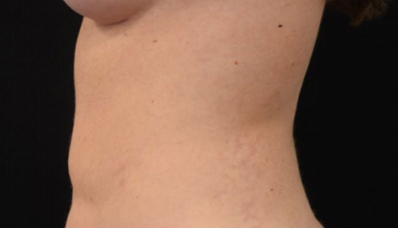 Liposuction Before & After Gallery - Patient 102564188 - Image 6