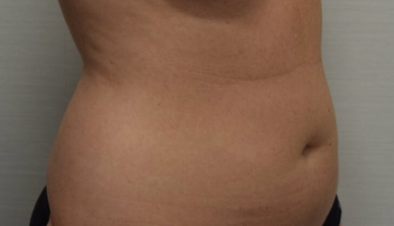 Liposuction Before & After Gallery - Patient 102564188 - Image 7
