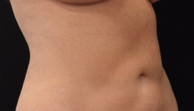 Liposuction Before & After Gallery - Patient 102564188 - Image 8