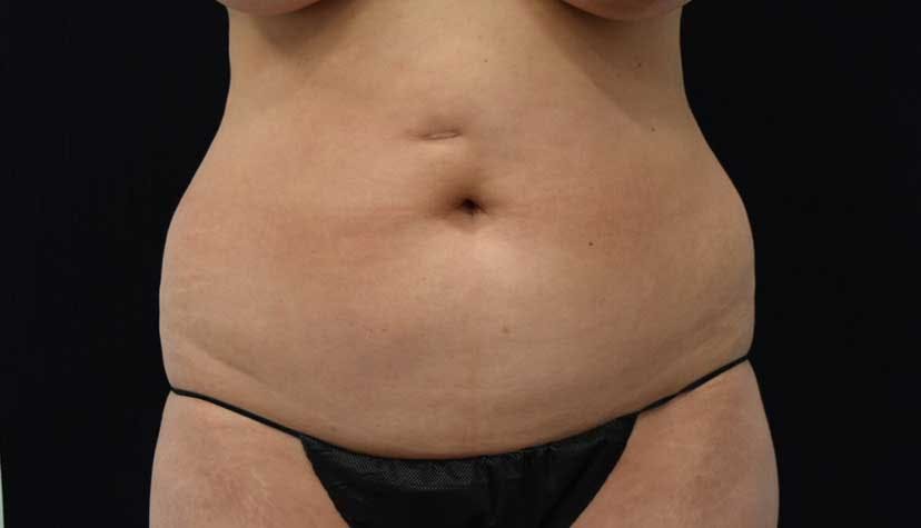 Liposuction