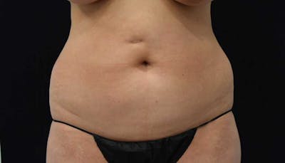 Liposuction Before & After Gallery - Patient 102564208 - Image 1