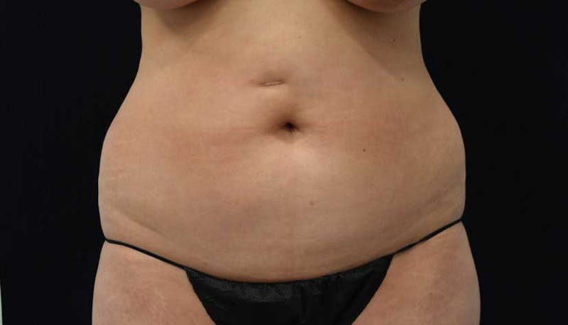 Liposuction Gallery - Patient 102564208 - Image 1