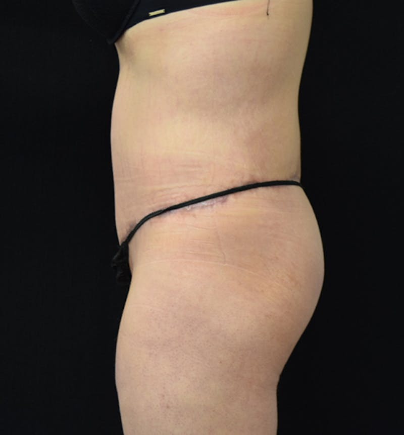 Lower Body Lift Before & After Gallery - Patient 102564202 - Image 6