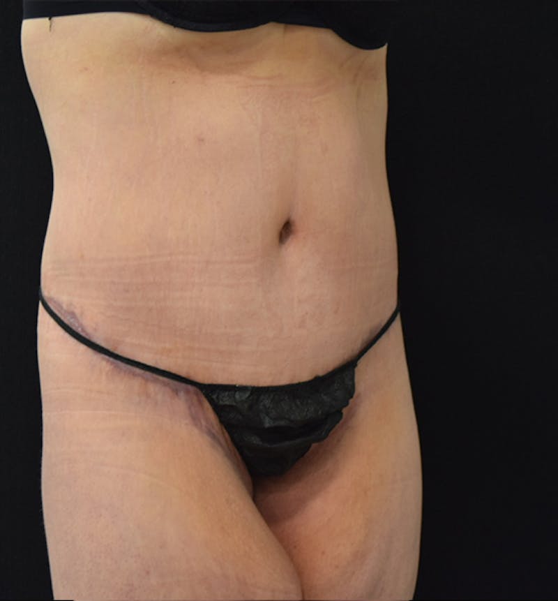 Lower Body Lift Before & After Gallery - Patient 102564202 - Image 8